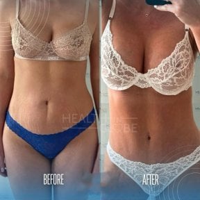 before-after photo mommy-makeover