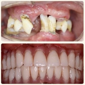 before-after photo all-on-4-dental-implants