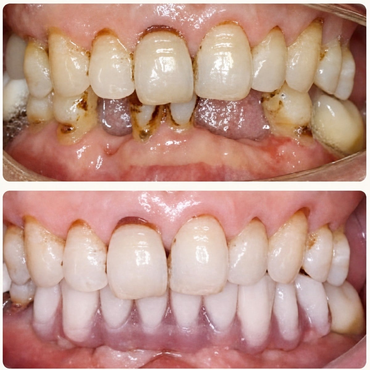 Resultados antes y después de implantes dentales All-on-4 en Wuhan Yiya Simei Dental Hospital