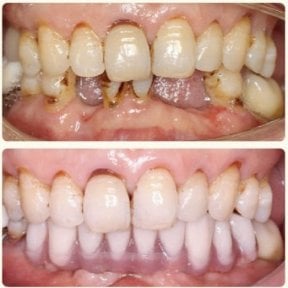 before-after photo all-on-4-dental-implants