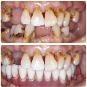 Before and after All-on-6 dental implants result at Wuhan Yiya Simei Dental Hospital, improved smile