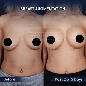 before-after photo breast-implants-with-breast-lift