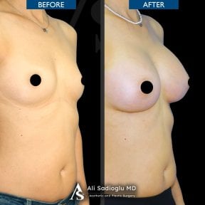 before-after photo breast-implants-with-breast-lift