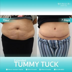 before-after photo liposuction