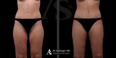before-after photo arms-plastics-brachioplasty