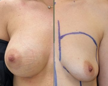 before-after photo mommy-makeover
