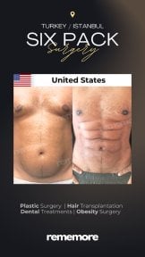 before-after photo liposuction