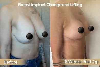 before-after photo breast-implants-with-breast-lift
