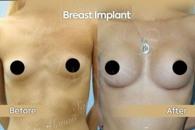 before-after photo breast-implants-with-breast-lift
