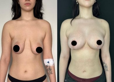 before-after photo breast-implants-with-breast-lift
