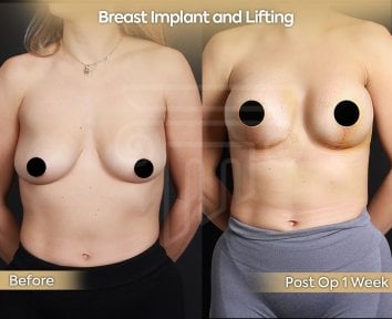 before-after photo breast-implants-with-breast-lift
