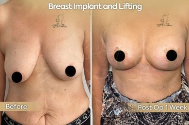 before-after photo breast-implants-with-breast-lift