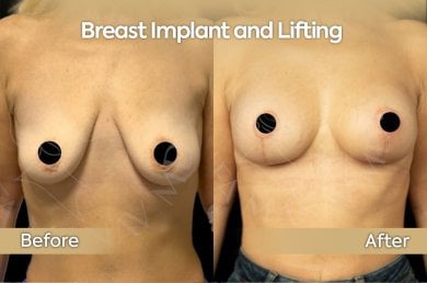 before-after photo breast-implants-with-breast-lift