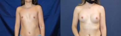 before-after photo operacia-po-zamene-grudnyh-implantov