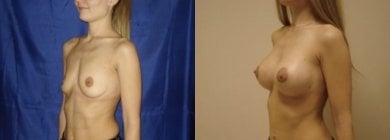 before-after photo operacia-po-zamene-grudnyh-implantov