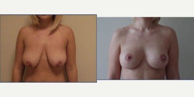 before-after photo podtazka-grudi-s-uveliceniem