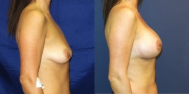 before-after photo podtazka-grudi-s-uveliceniem
