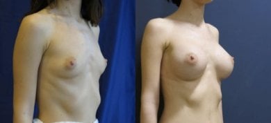 before-after photo podtazka-grudi-s-uveliceniem