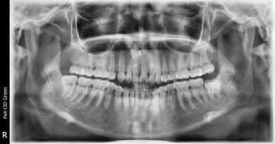 before-after photo wisdom-tooth-removal
