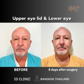 Before and after lower eyelid blepharoplasty results at ID Clinic Bangkok, 8 days post-op