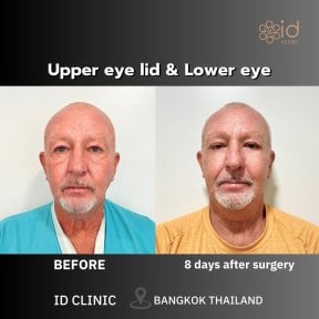Before and after upper and lower eyelid surgery results at ID Clinic Bangkok, 8 days post-op