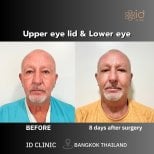 Before and after upper and lower eyelid surgery results at ID Clinic Bangkok, 8 days post-op