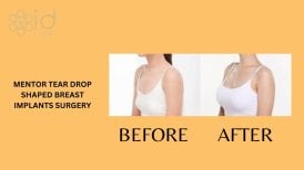До и после коррекции грудных имплантов в ID Clinic Bangkok, результат каплевидных имплантов