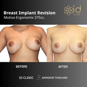 Результат до и после коррекции грудных имплантов в ID Clinic Bangkok, Motiva 375cc