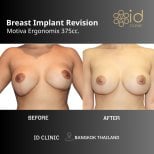 Результат до и после коррекции грудных имплантов в ID Clinic Bangkok, Motiva 375cc