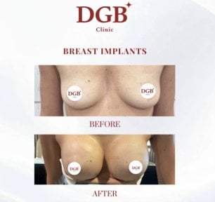 Before and after breast augmentation results at DGB Clinic, fuller breast contour achieved
