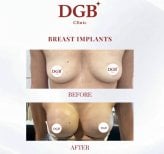 Before and after breast augmentation results at DGB Clinic, fuller breast contour achieved