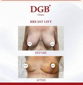 before-after photo uvelicenie-grudi