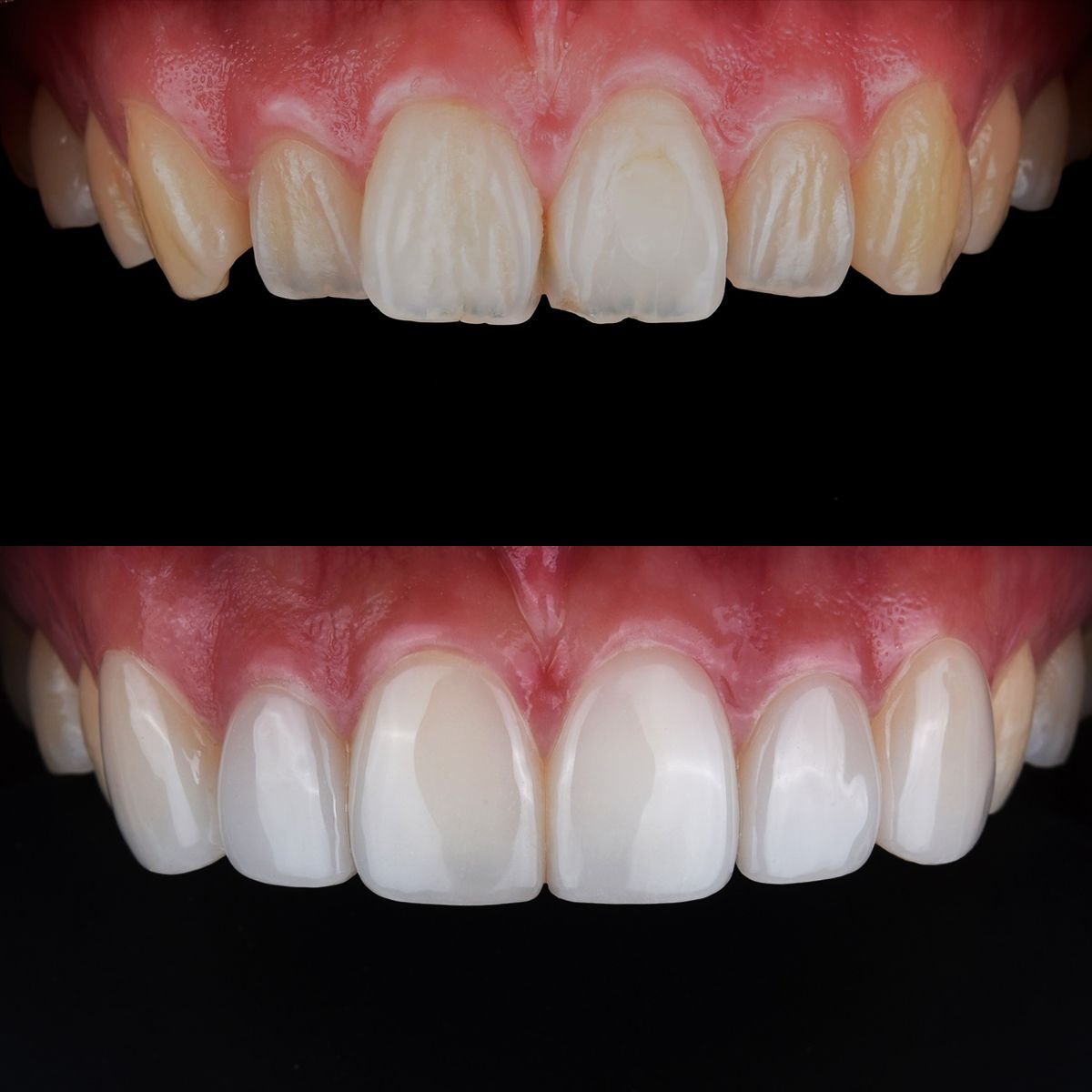 Resultado antes y después de carillas en 365 Seoul OneTop Dental Clinic, transformación de sonrisa