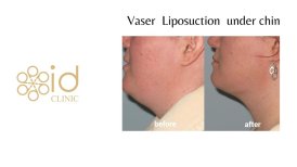 До и после Vaser липосакции подбородка в ID Clinic Bangkok, результат уменьшения двойного подбородка