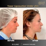 До и после Vaser липосакции подбородка в ID Clinic Bangkok, видимый контурный результат