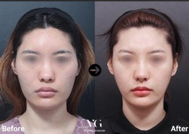 До та після контурингу лінії щелепи у VG Plastic Surgery, покращений овал обличчя