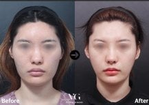 До та після контурингу лінії щелепи у VG Plastic Surgery, покращений овал обличчя