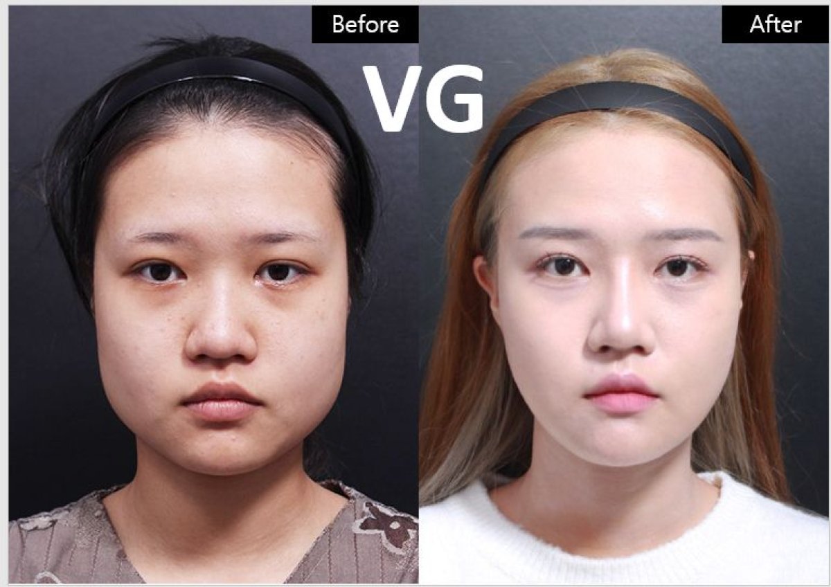 نتائج تحديد خط الفك قبل وبعد في VG Plastic Surgery مع إبراز نحافة الوجه