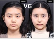 Результати до та після контурингу щелепи у VG Plastic Surgery – виразна форма обличчя