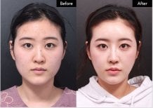 До та після контурингу лінії щелепи у VG Plastic Surgery, виражений результат