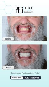 Before and after immediate load dental implant results at YEG Clinic – full smile restoration