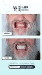 Before and after immediate load dental implant results at YEG Clinic – full smile restoration