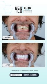 Immediate load dental implant before and after results at YEG Clinic, improved smile transformation