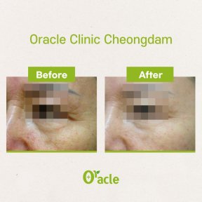 Результати до і після ультерапії в Oracle Clinic Cheongdam, помітне підтягнення шкіри