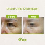 Результати до і після ультерапії в Oracle Clinic Cheongdam, помітне підтягнення шкіри