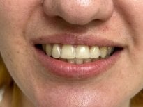 Resultado de unión dental en VerMax Dental Clinic: mejora de forma y color de dientes frontales