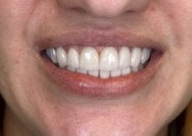 Resultado de bonding dental en VerMax Dental Clinic: mejora de forma y color dental