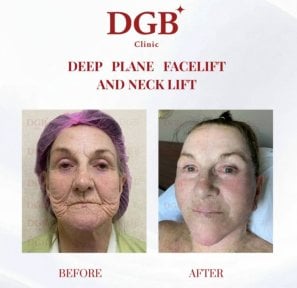 Before and after neck lift and deep plane facelift results at DGB Clinic, visible rejuvenation