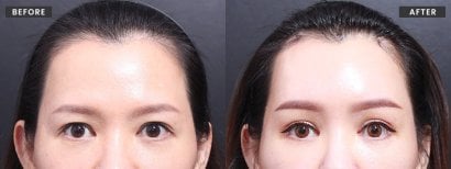 Before and after blepharoplasty results at VG Plastic Surgery – eyelid correction improvement