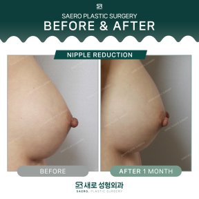 Résultats avant et après réduction du mamelon chez SAERO Plastic Surgery, 1 mois après